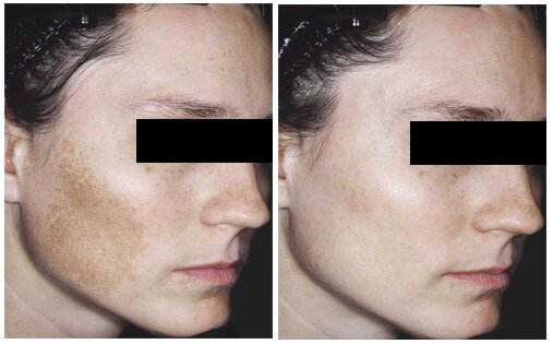 Melasma Before After