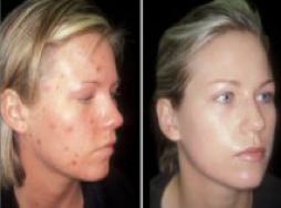 Meladerm Cream Before After