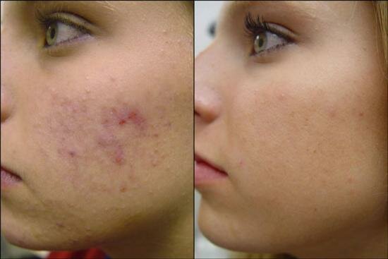 Before And After Neutrogena Skin ID