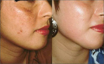 Best Microdermabrasion Machine