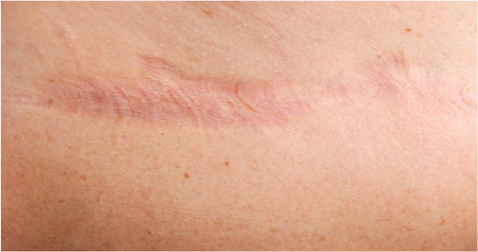 Scar Surgery