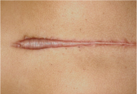Types of Scars